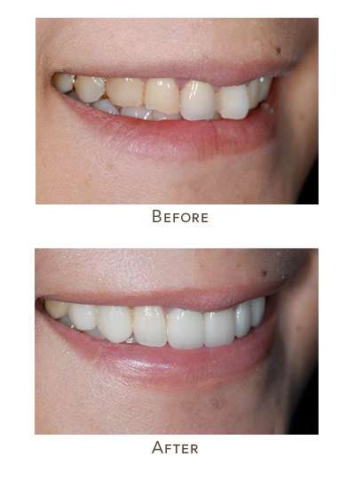 straighten misaligned front teeth without braces before after